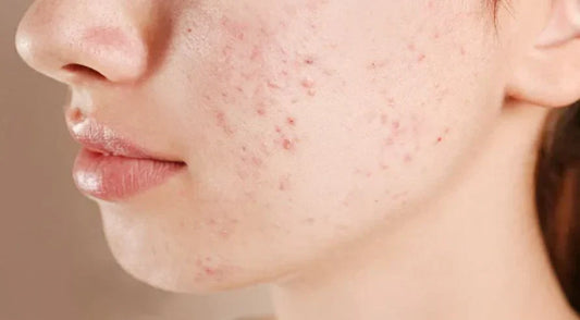 Blue Light Therapy for Acne Vulgaris: Key Parameters and Factors Influencing Efficacy