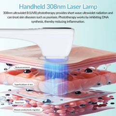 ZJZK Excimer Therapy UV Light And Psoriasis UVB Light For Viral Infectious Skin Disease